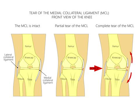 Medial Collateral Ligament (MCL)Tear: Treatment & Recovery Time.